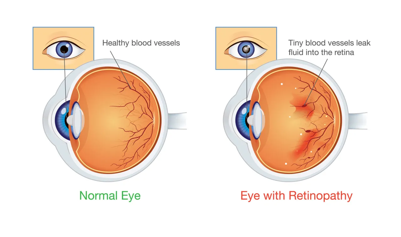 A medical illustration showing the progression of diabetic retinopathy in the eye.