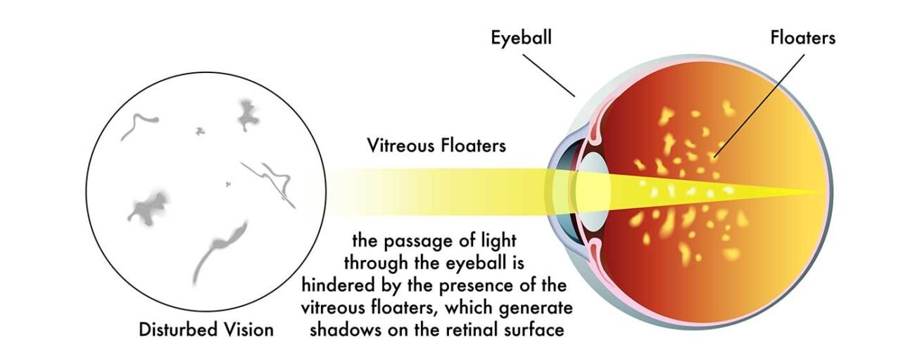 A close-up image of eye floaters, small specks and strands floating in a clear field of vision.